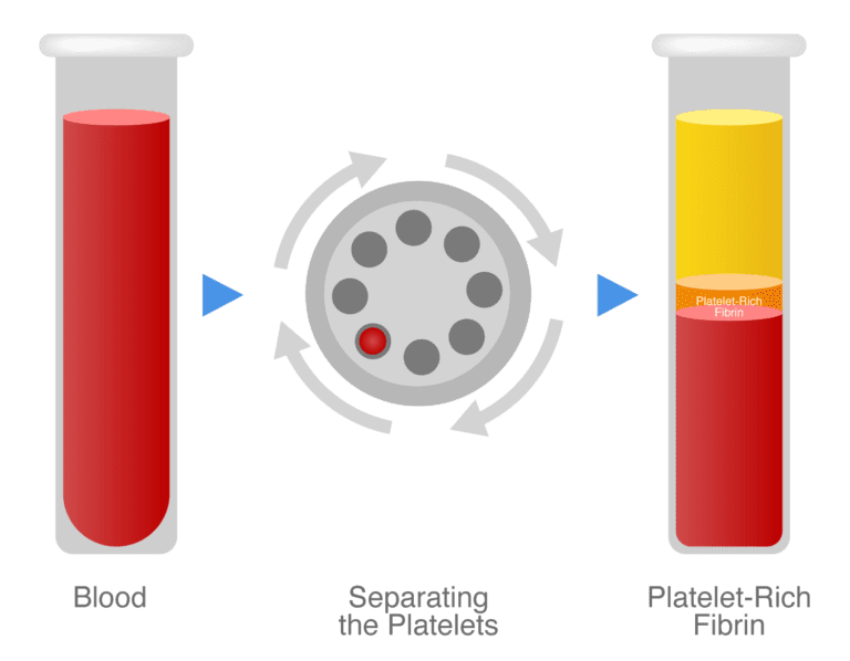 What are the different types of platelet-rich plasma PRP in the world?