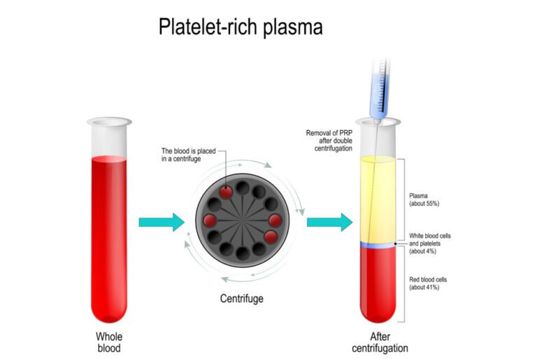 Mechanism of Platelet Rich Plasma (PRP) Therapy to Promote Tissue Healing