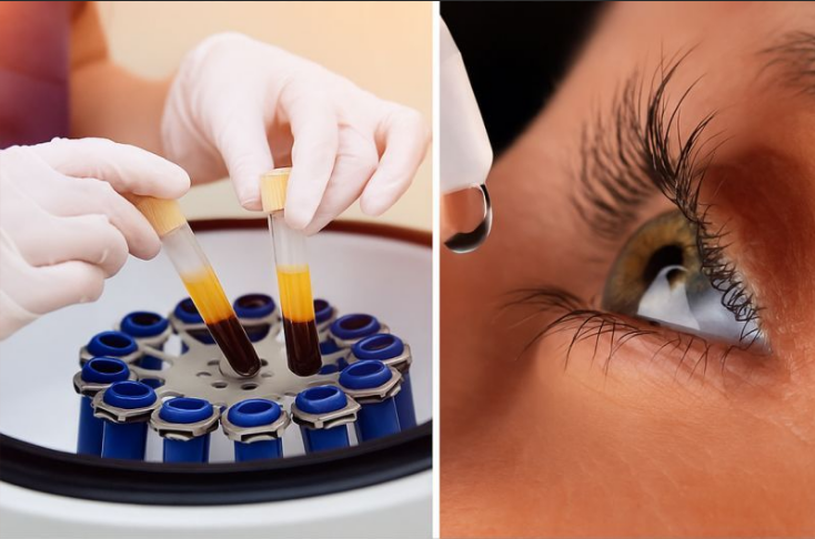 PRP for Dry Eyes